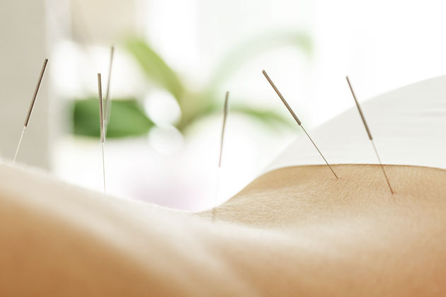 Was ist Akupunktur und wie wirkt sie